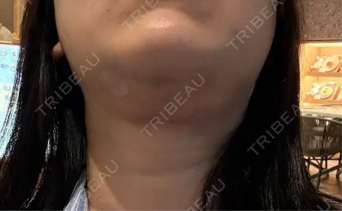 脂肪吸引（顔） / 脂肪吸引注射（顔） ziz CLINIC DAY 1 メイン用