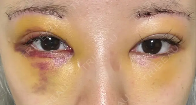 下まぶたの脂肪取り / 眉下切開 東京中央クリニック DAY 3 メイン用