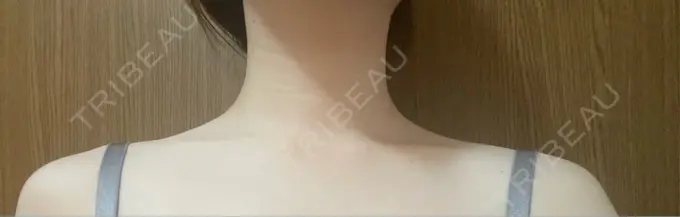 ボトックス（口角） / ボトックス（肩） TCB東京中央美容外科 浜松院 DAY 0 メイン用