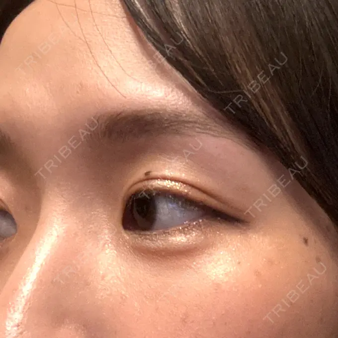 二重埋没 / ヒアルロン酸注入（涙袋） 湘南美容クリニック 宇都宮院 DAY 7 メイン用