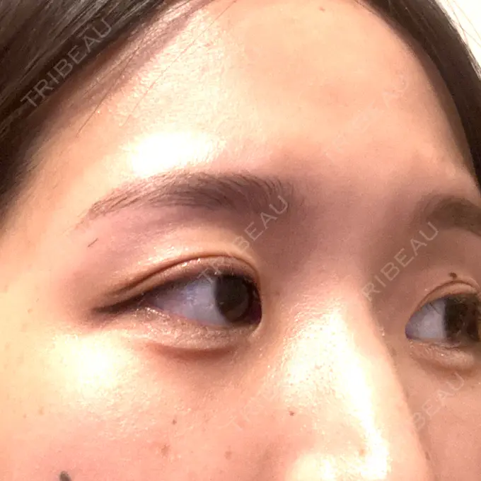 二重埋没 / ヒアルロン酸注入（涙袋） 湘南美容クリニック 宇都宮院 DAY 7 メイン用