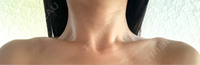 ボトックス（肩） APスキンクリニック銀座 DAY 6 メイン用