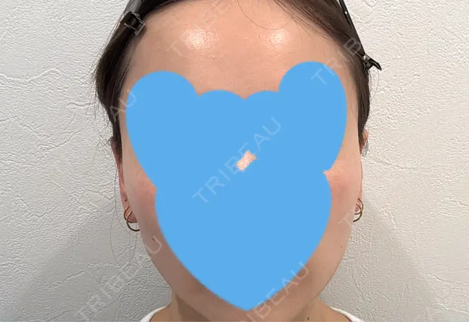 糸リフト / シワ取りボトックス / ボトックス（眉間） アリエル美容クリニック 横浜院 DAY 26 メイン用