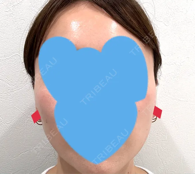 糸リフト / シワ取りボトックス / ボトックス（眉間） アリエル美容クリニック 横浜院 DAY 27 メイン用