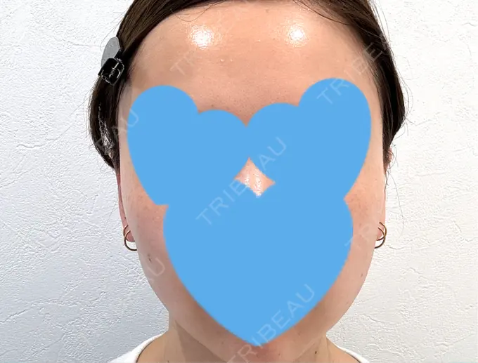 糸リフト / シワ取りボトックス / ボトックス（眉間） アリエル美容クリニック 横浜院 DAY 28 メイン用