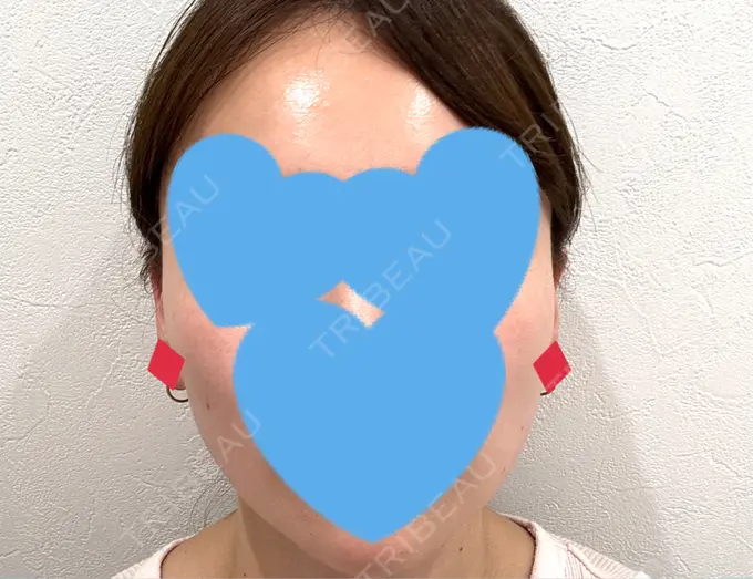 糸リフト / シワ取りボトックス / ボトックス（眉間） アリエル美容クリニック 横浜院 DAY 29 メイン用