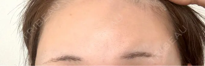 ボトックス（眉間） / ボトックス（額） DMTC美容皮膚科 大宮院 AFTER メイン用