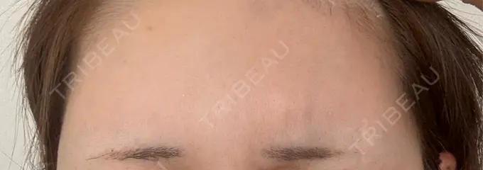 ボトックス（眉間） / ボトックス（額） DMTC美容皮膚科 大宮院 DAY 13 メイン用