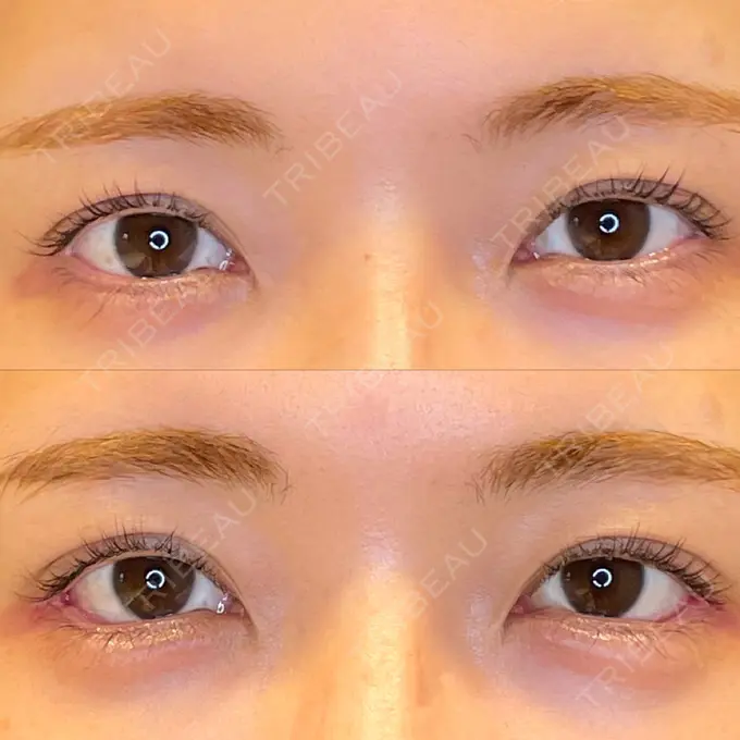 目尻切開 / 口角挙上 / タレ目形成・グラマラスライン（埋没） LOUIS CLINIC 二子玉川院【ルイクリニック】 AFTER メイン用