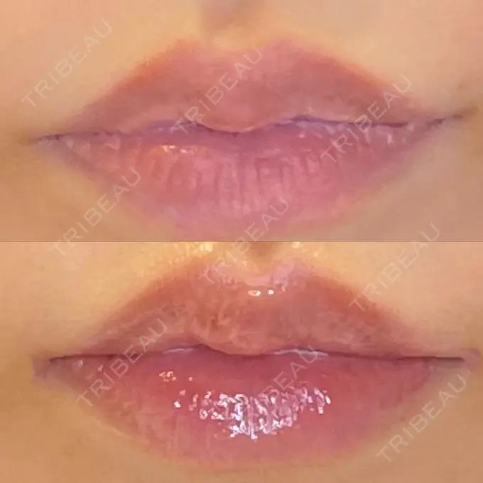 目尻切開 / 口角挙上 / タレ目形成・グラマラスライン（埋没） LOUIS CLINIC 二子玉川院【ルイクリニック】 DAY 6 メイン用