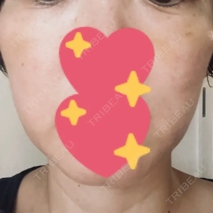 肌育注射（ジュベルックなど） B-LINE CLINIC 大阪院 DAY 8 メイン用