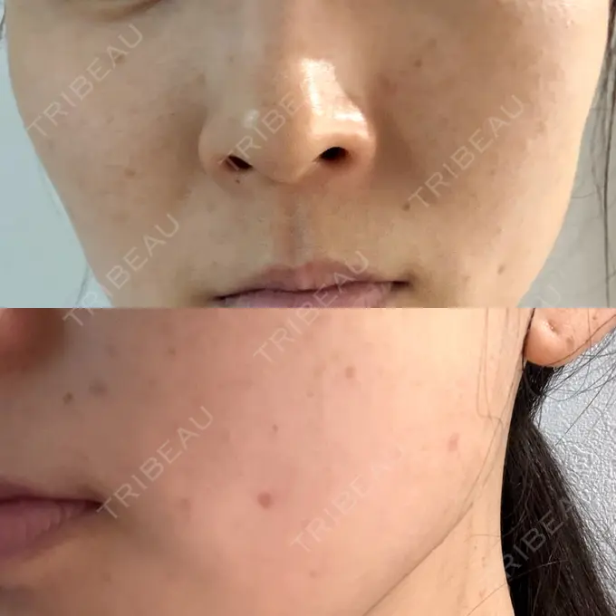 ルメッカ 大美会クリニック 岡山院 AFTER メイン用