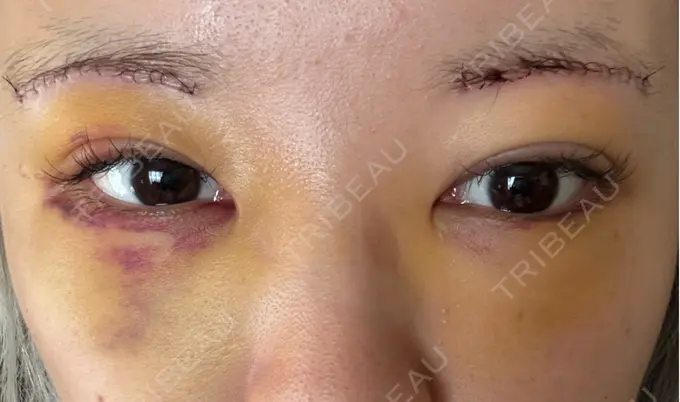 下まぶたの脂肪取り / 眉下切開 東京中央クリニック DAY 4 メイン用