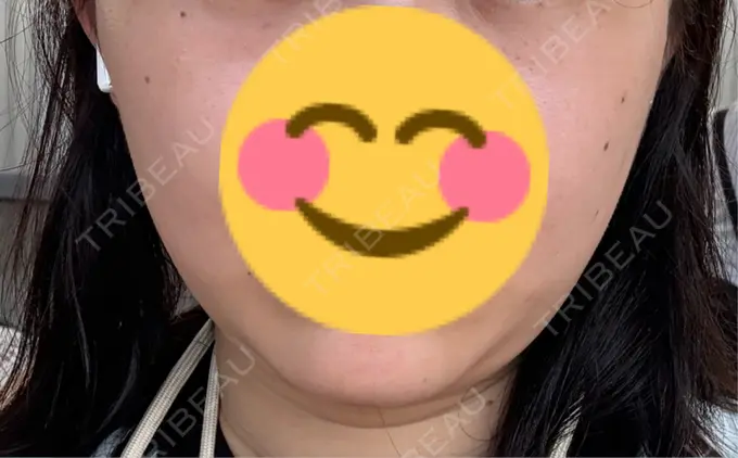 脂肪吸引（顔） / 脂肪吸引注射（顔） ziz CLINIC DAY 2 メイン用