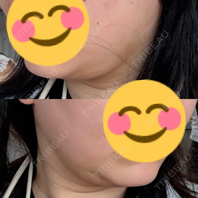 脂肪吸引（顔） / 脂肪吸引注射（顔） ziz CLINIC DAY 2 メイン用