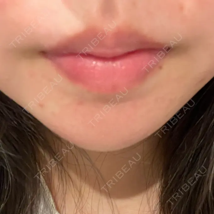 ボトックス（あご） / ボトックス（口角） / シワ取りボトックス LE CLINIC DAY 4 メイン用