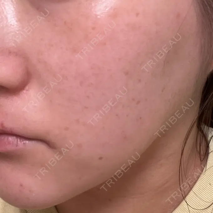 ルビーレーザー Designo Clinic （デジーノクリニック） AFTER メイン用