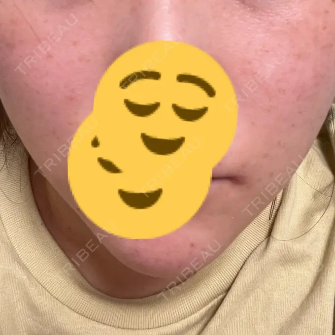 ルビーレーザー Designo Clinic （デジーノクリニック） DAY 7 メイン用