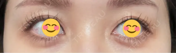 ヒアルロン酸注入（涙袋） AI Beauty Clinic （エーアイ美容クリニック） AFTER メイン用