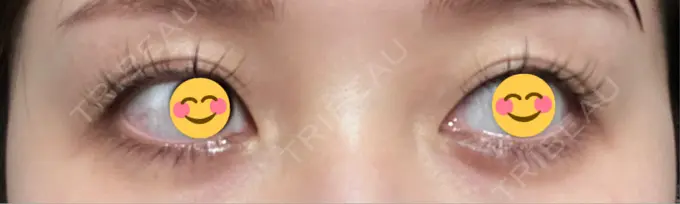 ヒアルロン酸注入（涙袋） AI Beauty Clinic （エーアイ美容クリニック） DAY 7 メイン用