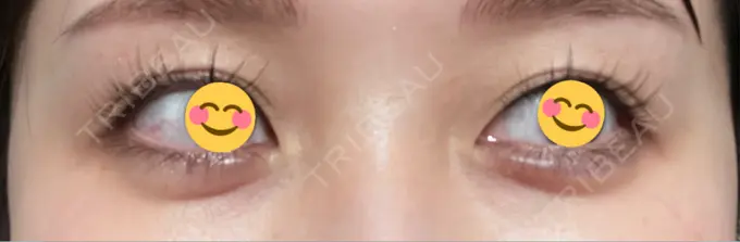 ヒアルロン酸注入（涙袋） AI Beauty Clinic （エーアイ美容クリニック） DAY 7 メイン用