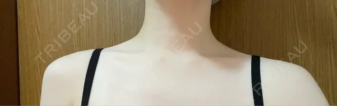 ボトックス（口角） / ボトックス（肩） TCB東京中央美容外科 浜松院 DAY 3 メイン用