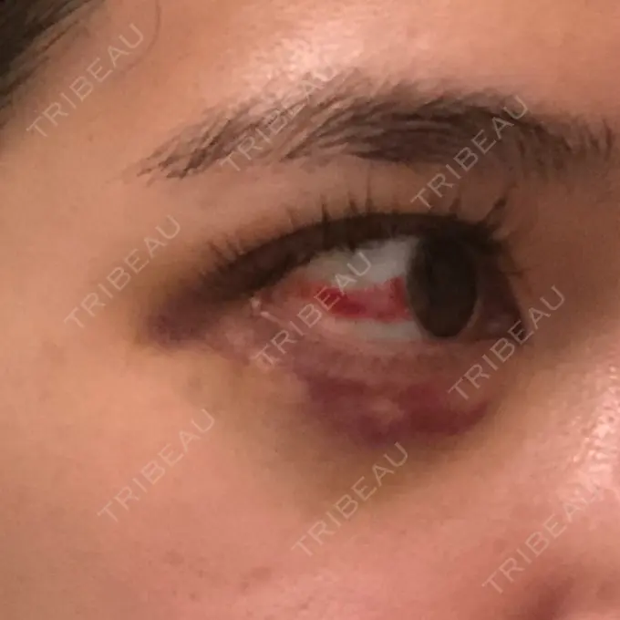 ヒアルロン酸注入（涙袋） / ヒアルロン酸注入（鼻） / ボトックス（エラ・小顔） / ヒアルロン酸注入（唇） TCB東京中央美容外科 新宿東口院 DAY 4 メイン用