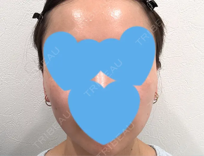 糸リフト / シワ取りボトックス / ボトックス（眉間） アリエル美容クリニック 横浜院 DAY 30 メイン用