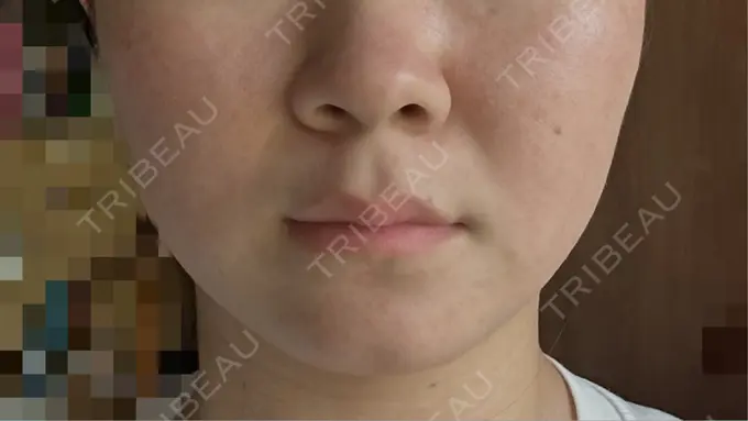 ボトックス（エラ・小顔） アリエル美容クリニック 横浜院 DAY 14 メイン用