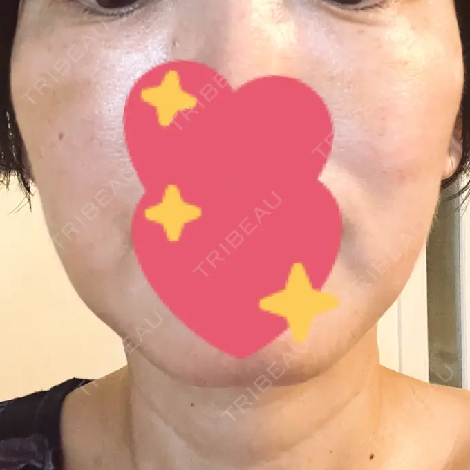 肌育注射（ジュベルックなど） B-LINE CLINIC 大阪院 DAY 9 メイン用