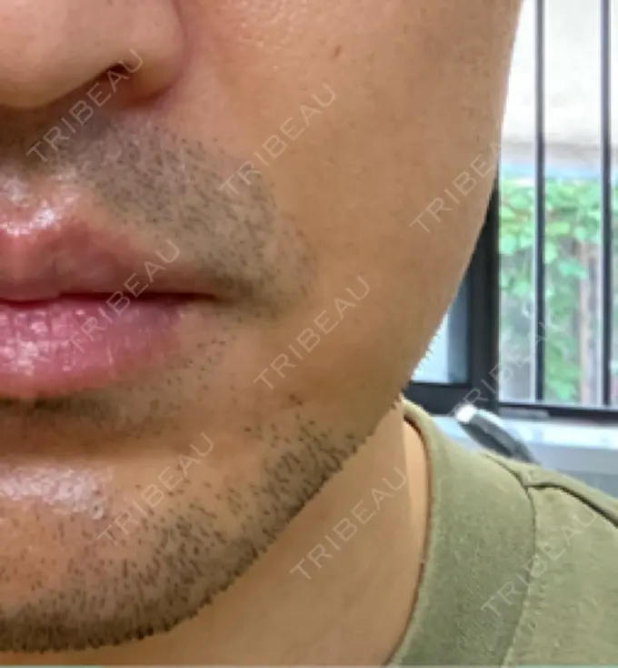 ボトックス（エラ・小顔） 品川スキンクリニック広島院 DAY 2 メイン用