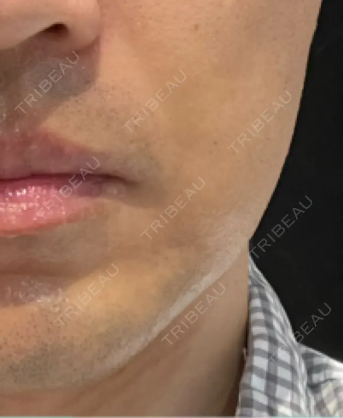 ボトックス（エラ・小顔） 品川スキンクリニック広島院 DAY 3 メイン用