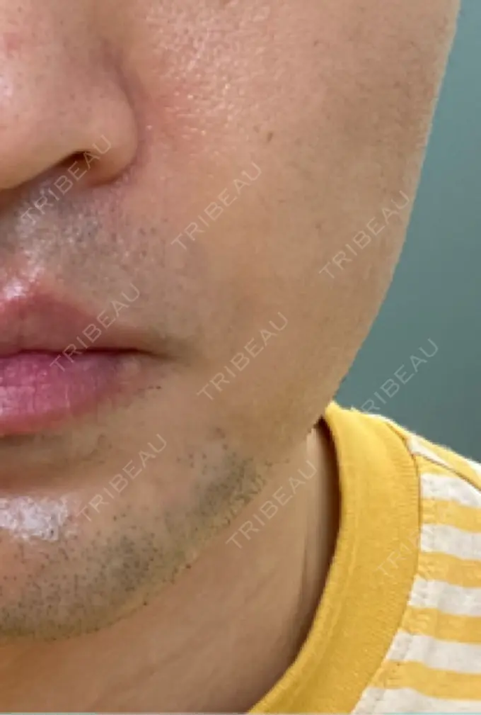 ボトックス（エラ・小顔） 品川スキンクリニック広島院 DAY 5 メイン用