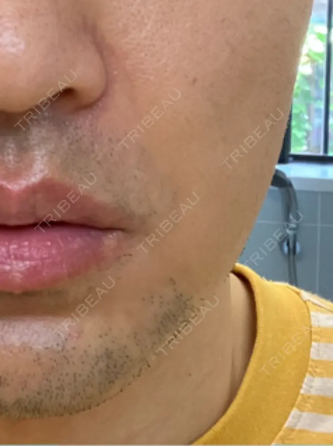 ボトックス（エラ・小顔） 品川スキンクリニック広島院 DAY 7 メイン用