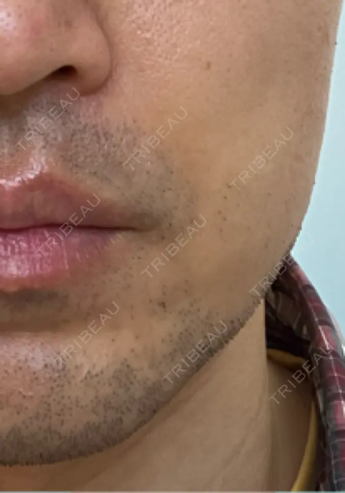 ボトックス（エラ・小顔） 品川スキンクリニック広島院 DAY 4 メイン用