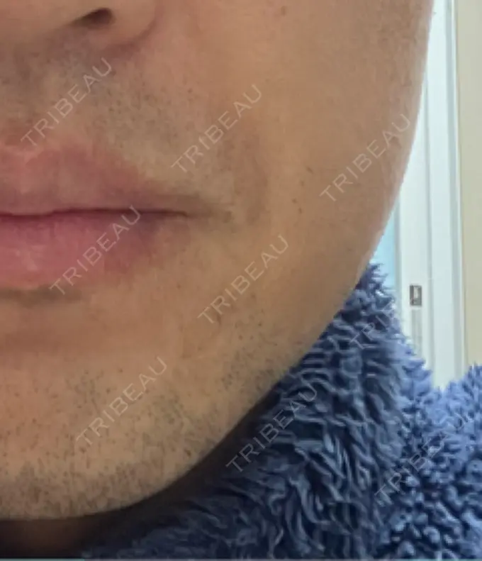 ボトックス（エラ・小顔） 品川スキンクリニック広島院 DAY 6 メイン用