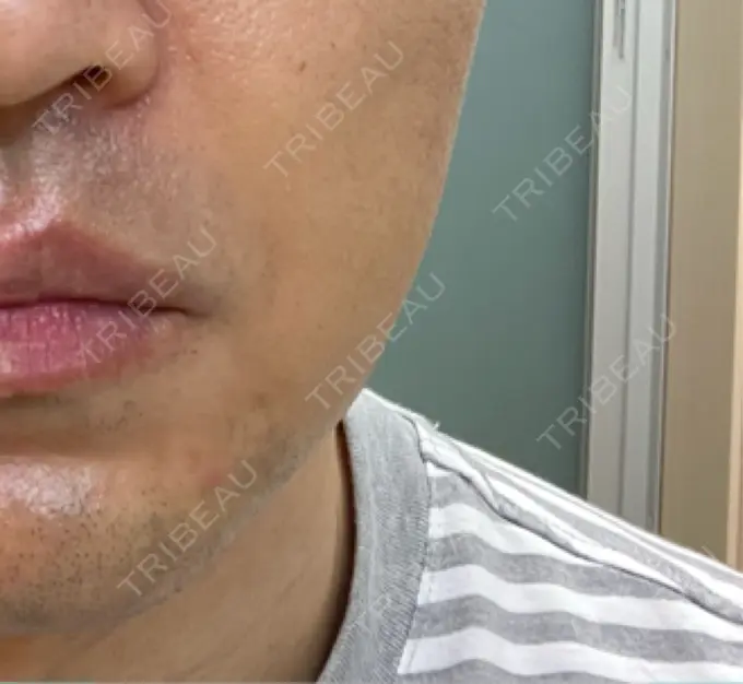 ボトックス（エラ・小顔） 品川スキンクリニック広島院 DAY 8 メイン用