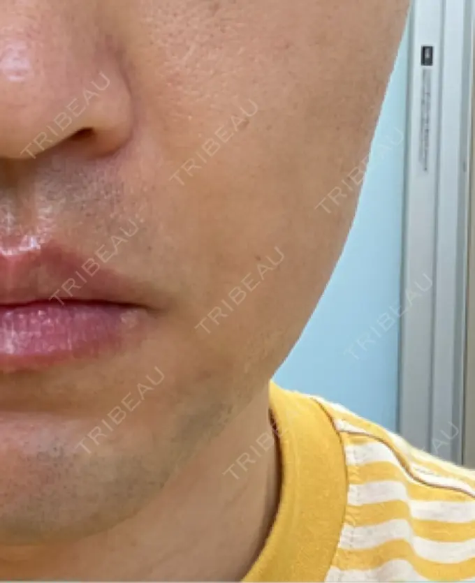 ボトックス（エラ・小顔） 品川スキンクリニック広島院 DAY 9 メイン用