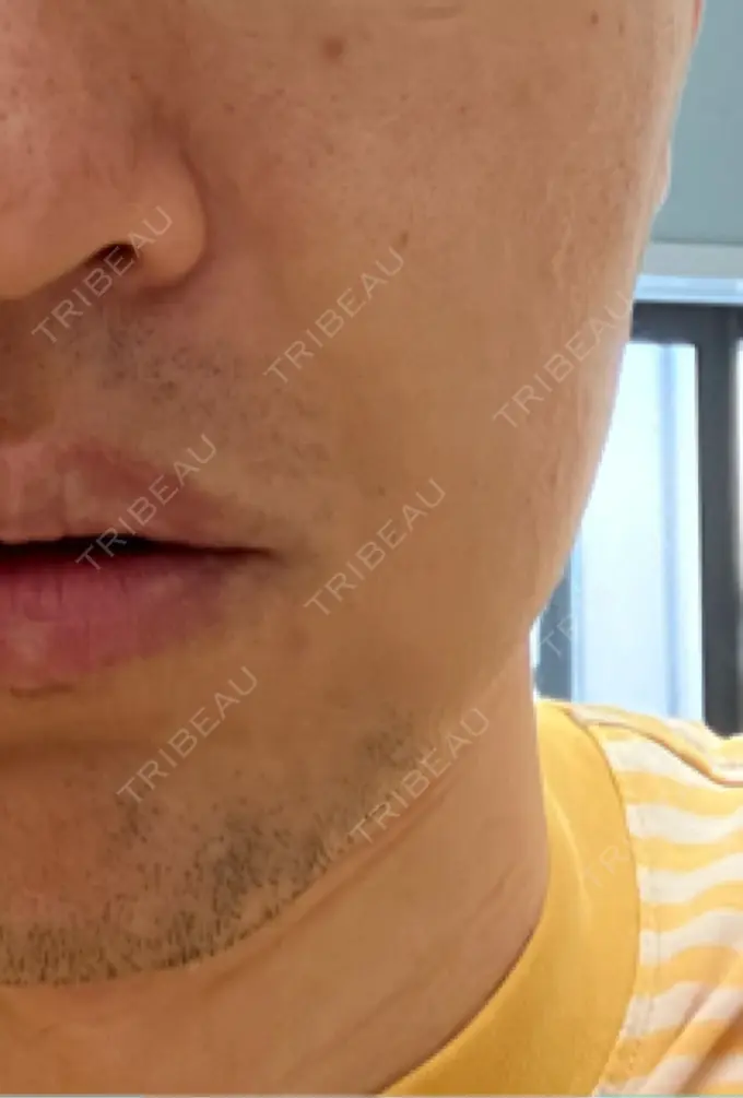 ボトックス（エラ・小顔） 品川スキンクリニック広島院 AFTER メイン用