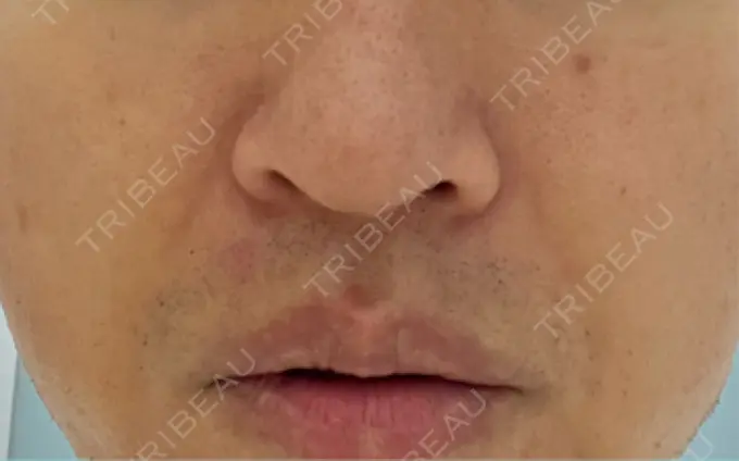 脂肪溶解注射（顔） TCB東京中央美容外科 広島院 DAY 4 メイン用