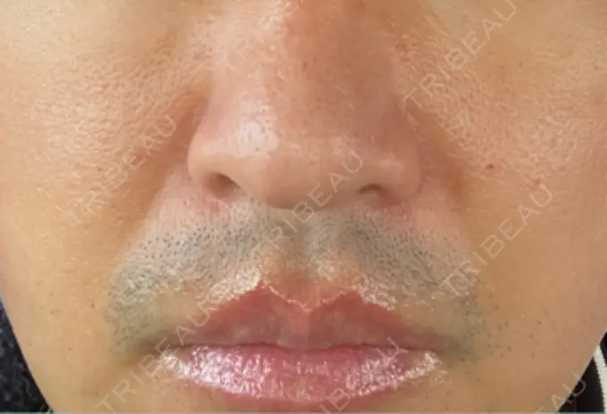 脂肪溶解注射（顔） TCB東京中央美容外科 広島院 DAY 2 メイン用