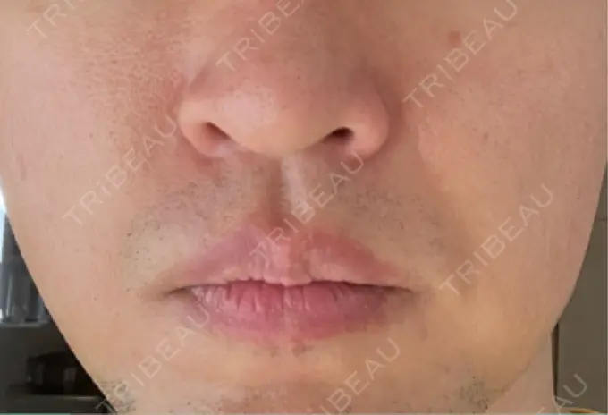 脂肪溶解注射（顔） TCB東京中央美容外科 広島院 DAY 3 メイン用