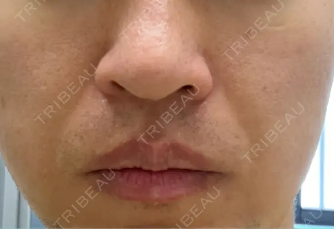 脂肪溶解注射（顔） TCB東京中央美容外科 広島院 DAY 6 メイン用