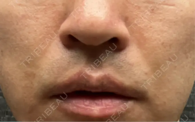 脂肪溶解注射（顔） TCB東京中央美容外科 広島院 DAY 7 メイン用