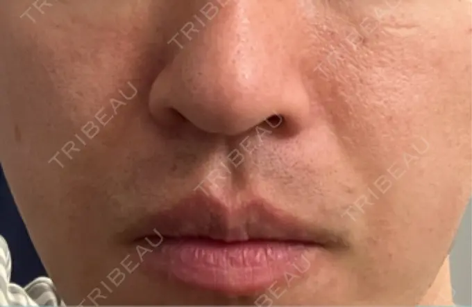 脂肪溶解注射（顔） TCB東京中央美容外科 広島院 DAY 8 メイン用