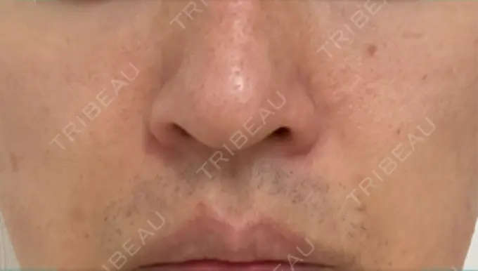 脂肪溶解注射（顔） TCB東京中央美容外科 広島院 DAY 9 メイン用