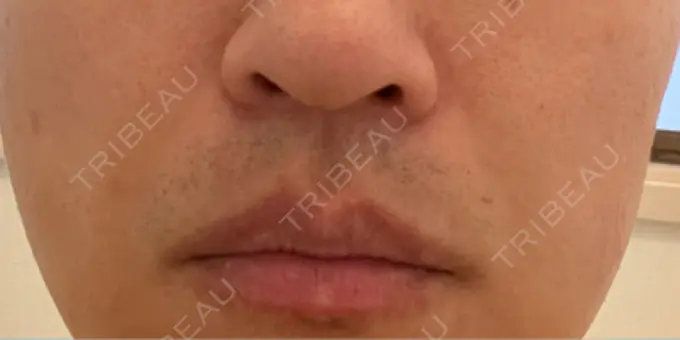 脂肪溶解注射（顔） TCB東京中央美容外科 広島院 AFTER メイン用