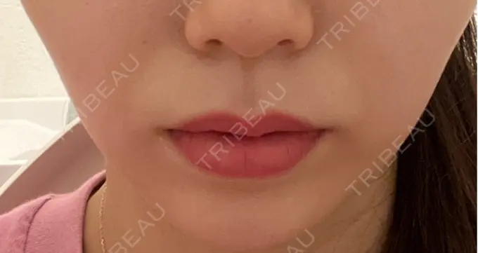 ボトックス（口角） ルラ美容クリニック 広島院 DAY 26 メイン用