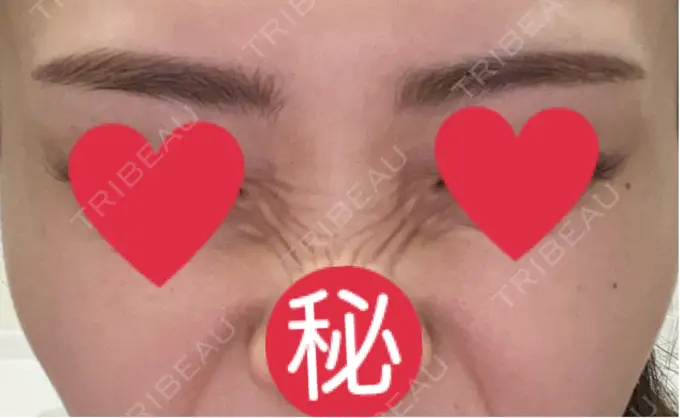 ボトックス（バニーライン） 共立美容外科 広島院 DAY 23 メイン用