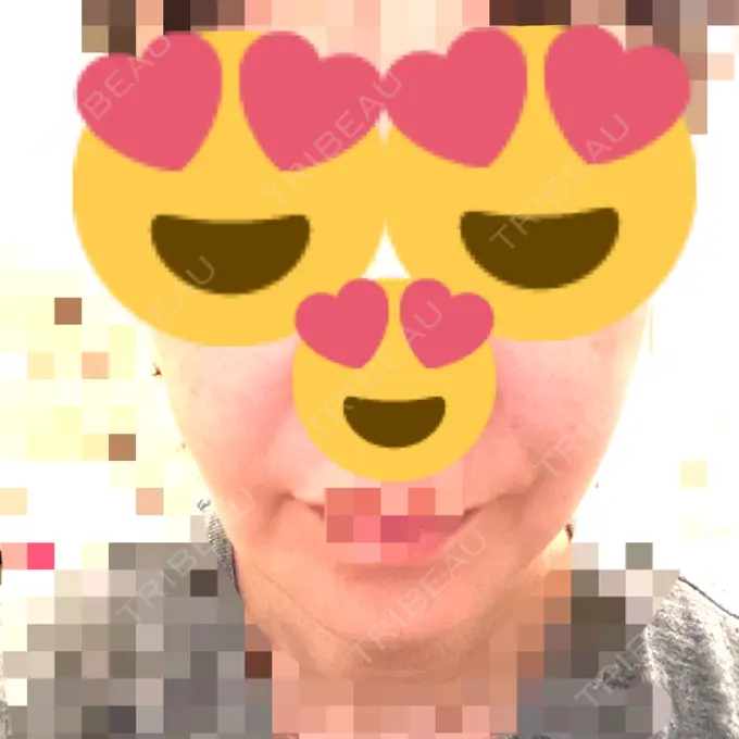 糸リフト アリエル美容クリニック 横浜院 DAY 26 メイン用